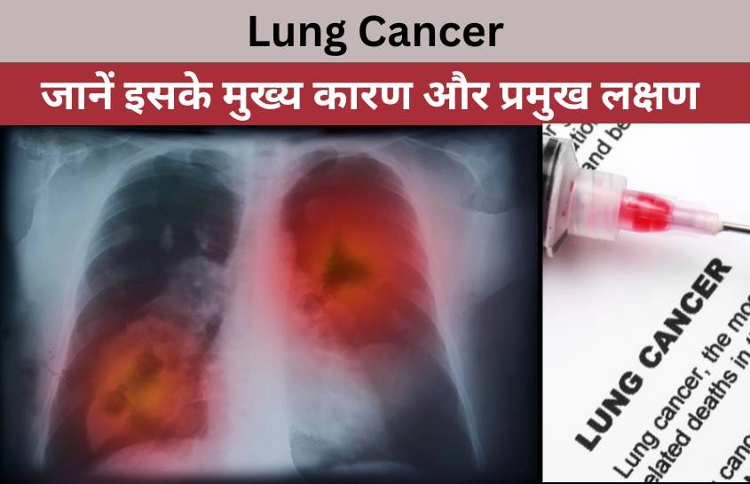 Lung Cancer