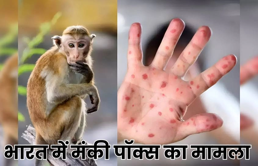 Monkey Pox In India