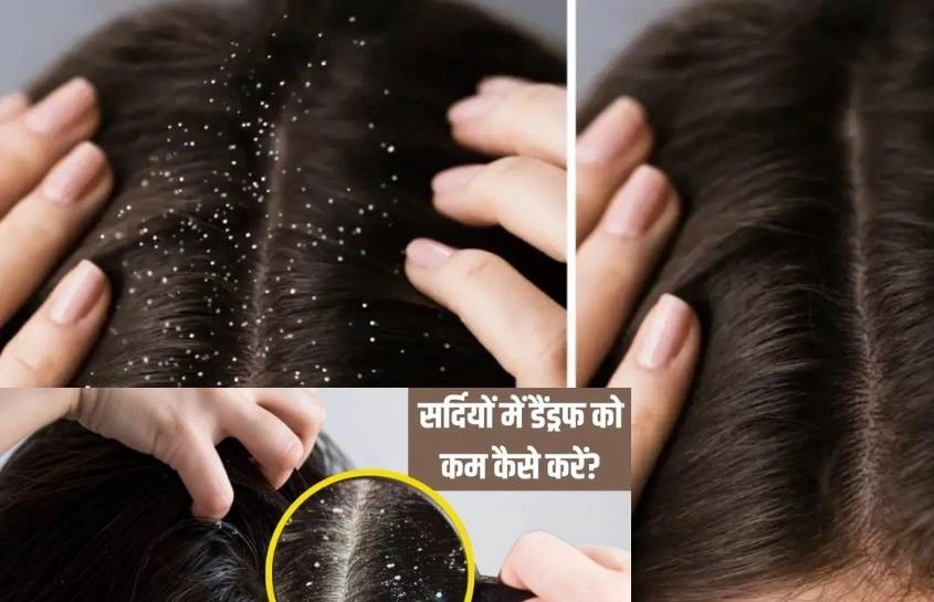 सर्दियों में बालों के Dandruff से हैं परेशान